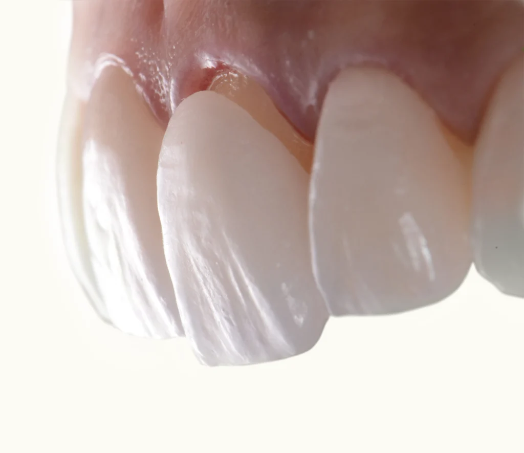 Common Problems With Veneers And How To Fix Them