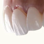 Common Problems With Veneers And How To Fix Them