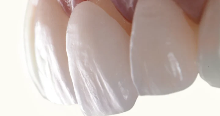 Common Problems With Veneers And How To Fix Them